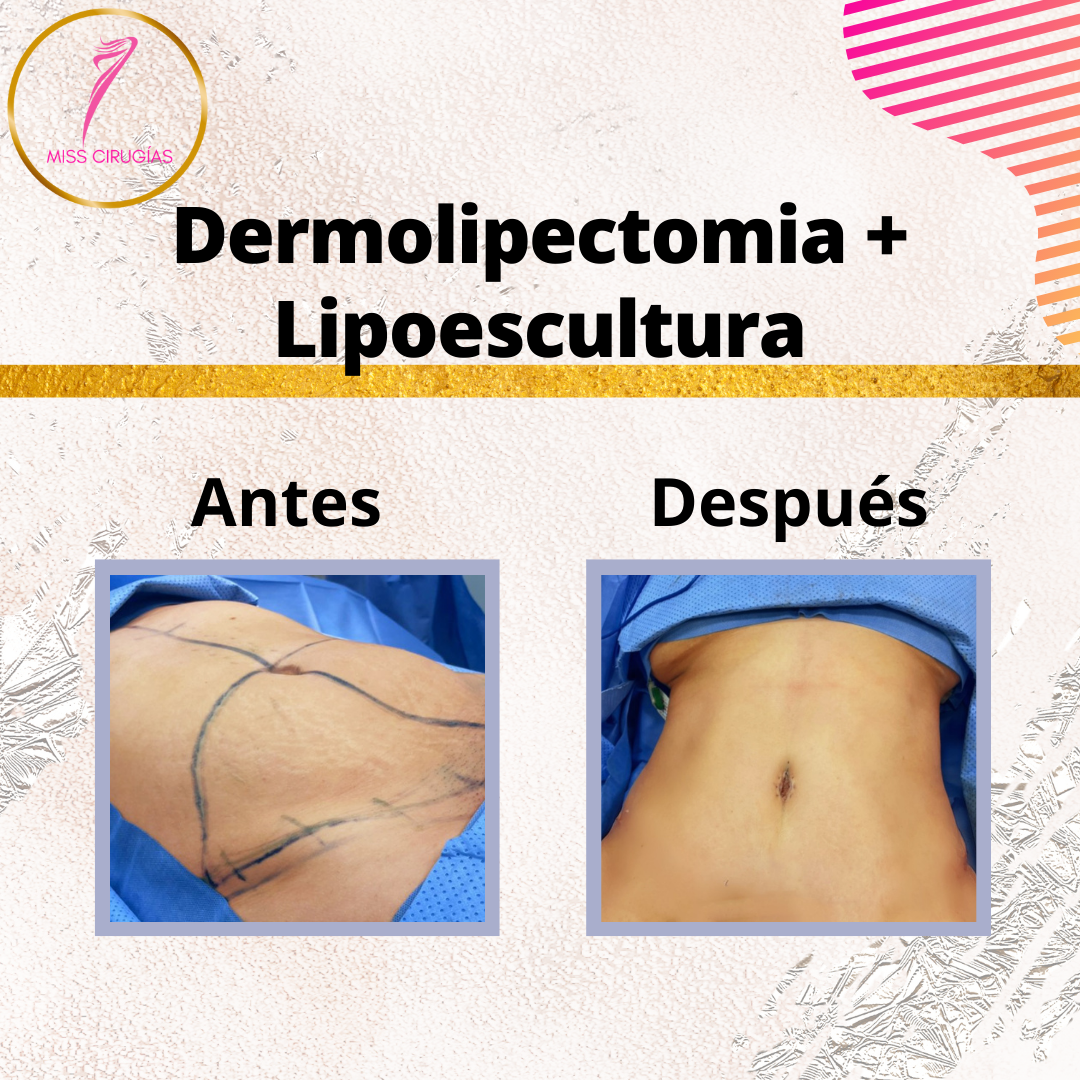 liposuccion-lipoescultura-dermolipectomia