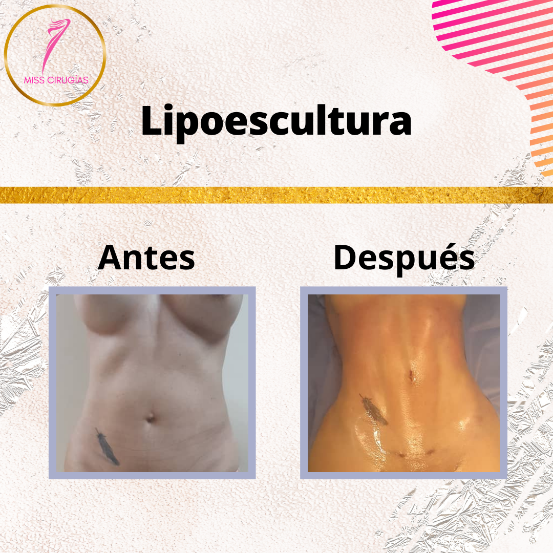 liposuccion-lipoescultura-dermolipectomia