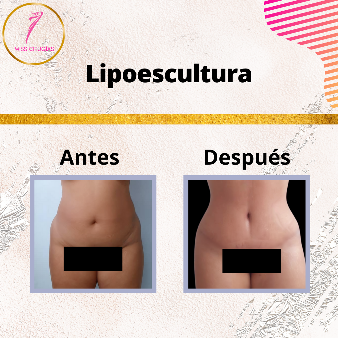 liposuccion-lipoescultura-dermolipectomia