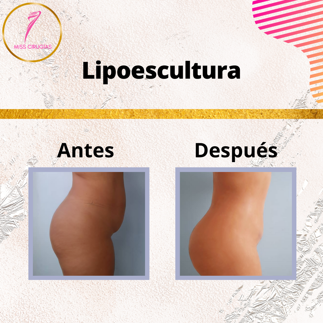 liposuccion-lipoescultura-dermolipectomia