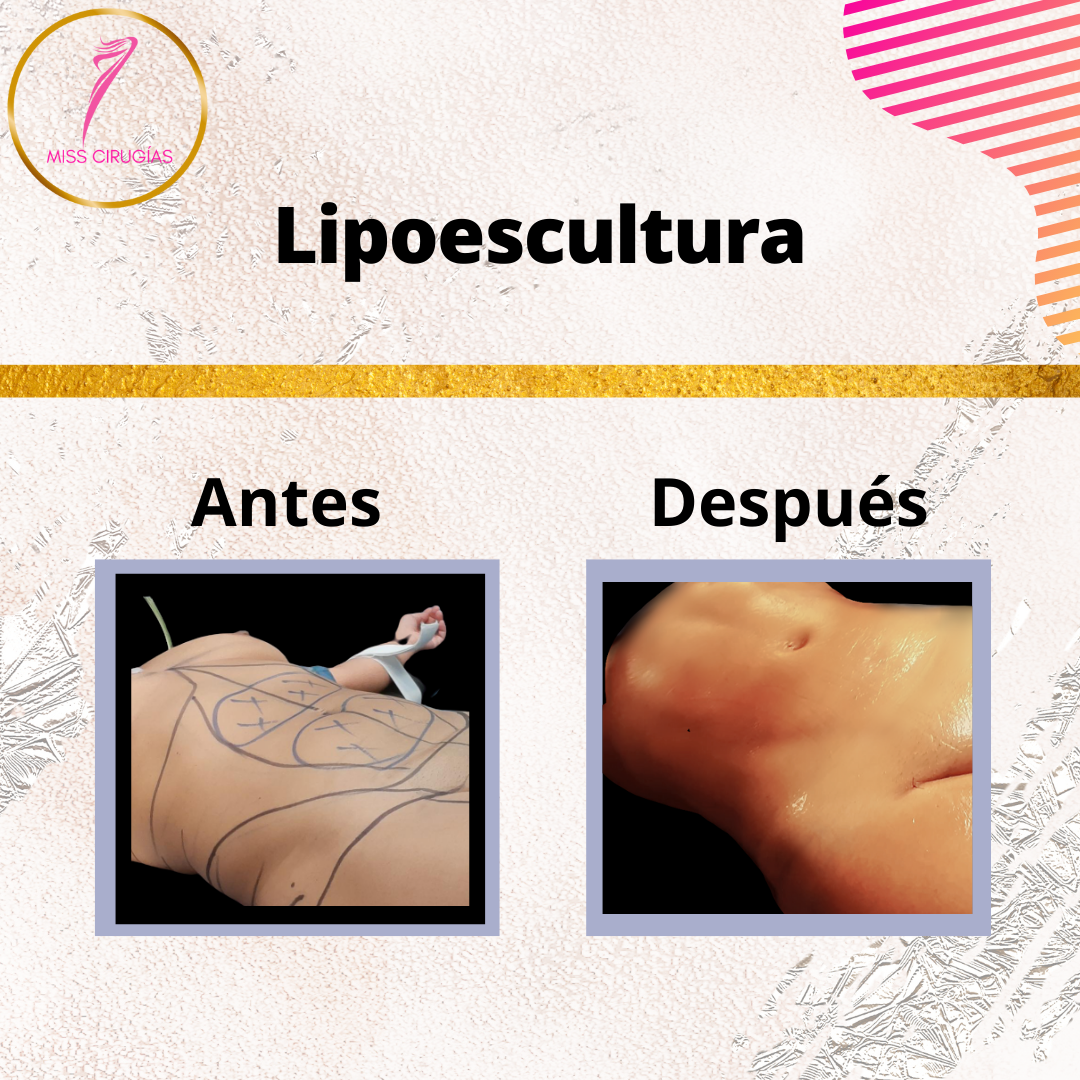 liposuccion-lipoescultura-dermolipectomia