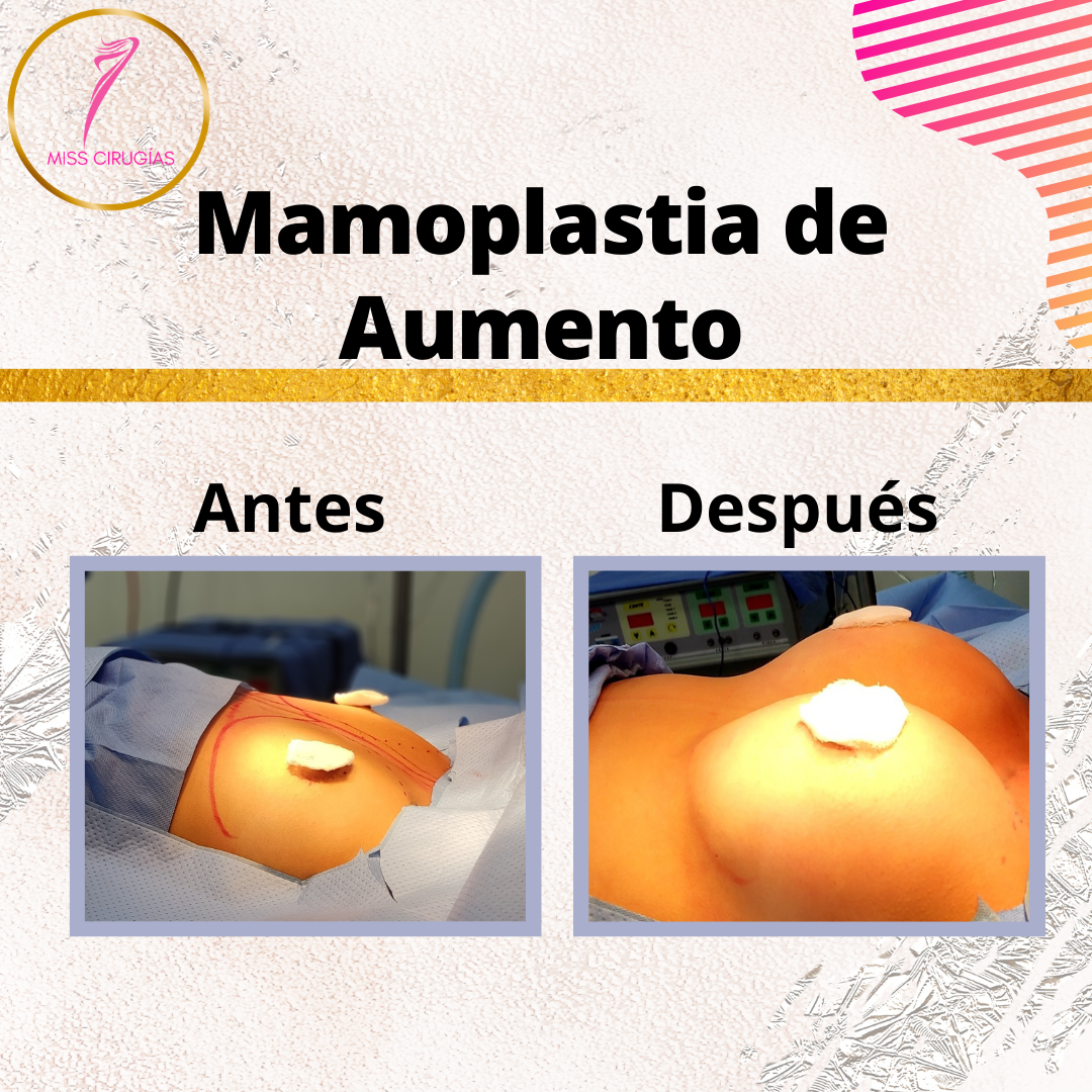 mamoplastia-pexia-mastopexia-misscirugias