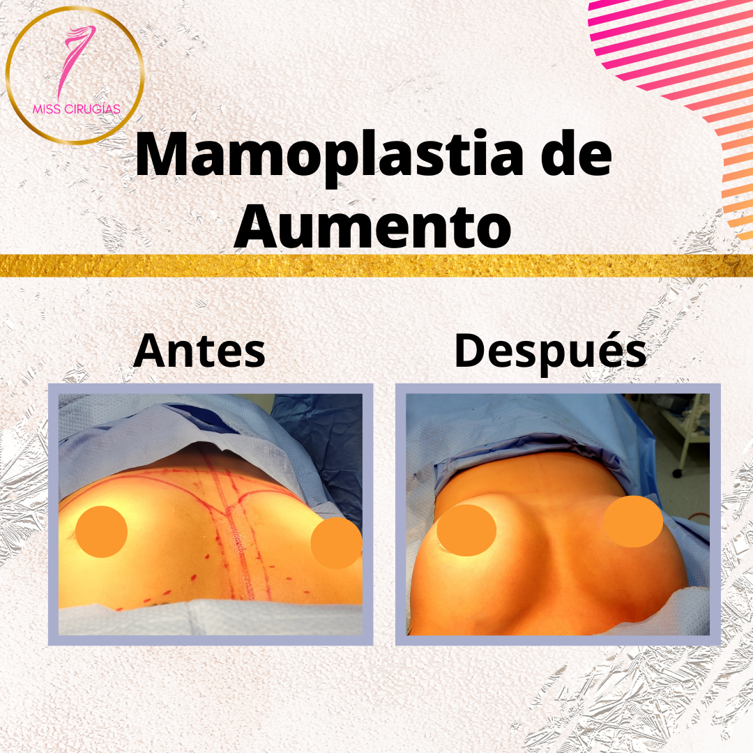 mamoplastia-pexia-mastopexia-misscirugias
