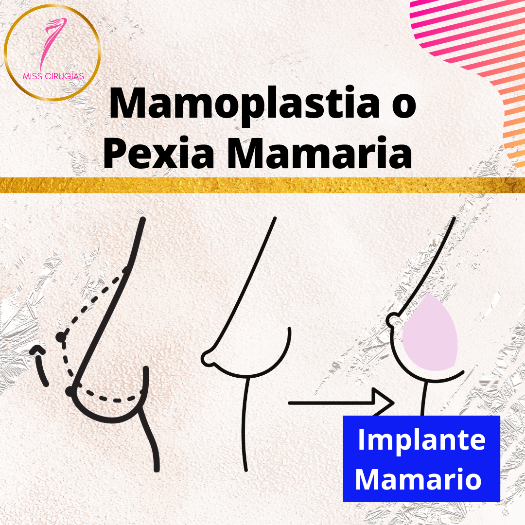 mamoplastia
