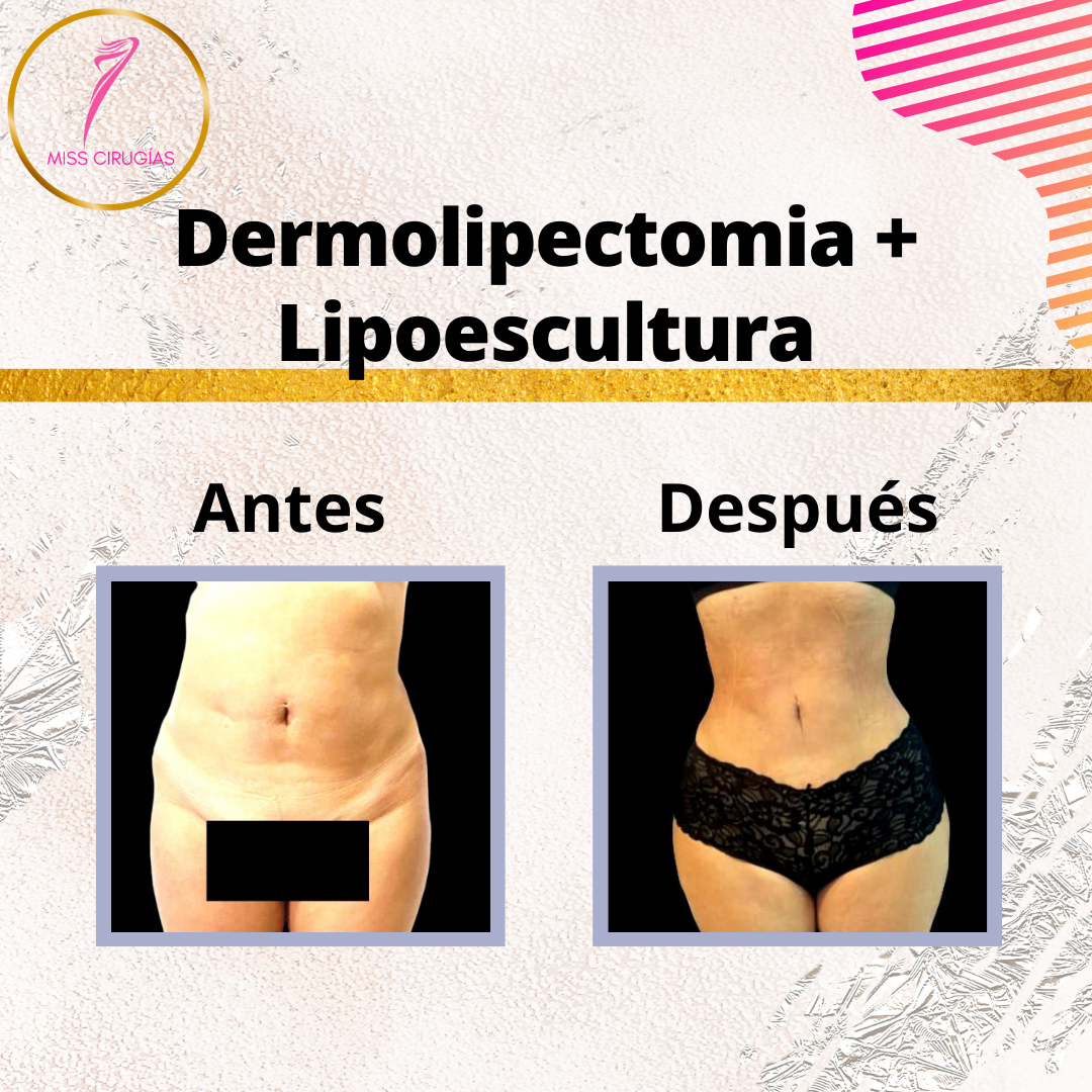 liposuccion-lipoescultura-misscirugias-vaser-heus