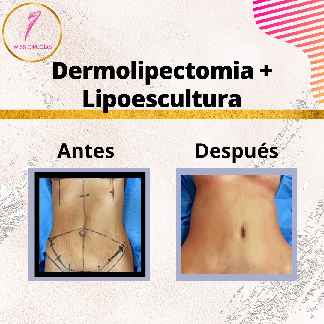 liposuccion-lipoescultura-dermolipectomia