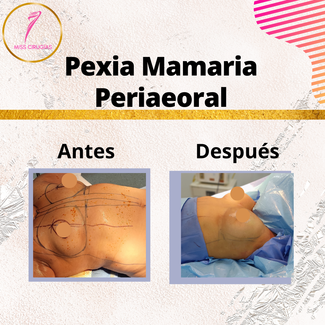 pexia-mamaria-misscirugias