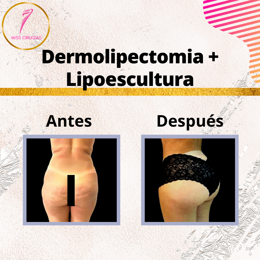liposuccion-lipoescultura-misscirugias-vaser-heus