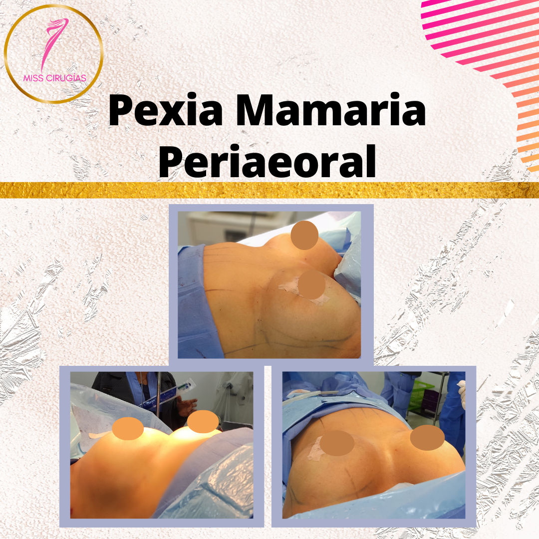 pexia-mamaria-misscirugias