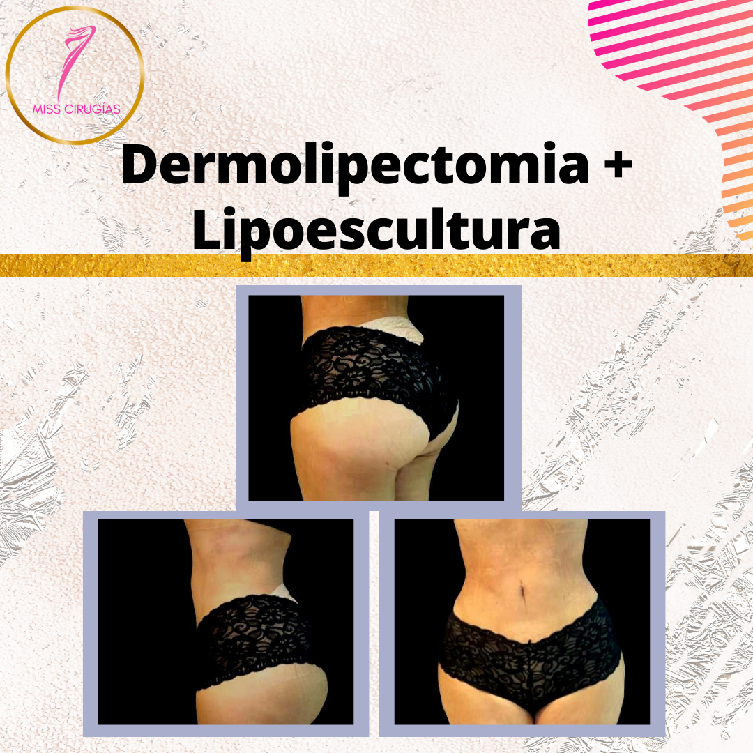 liposuccion-lipoescultura-misscirugias-vaser-heus