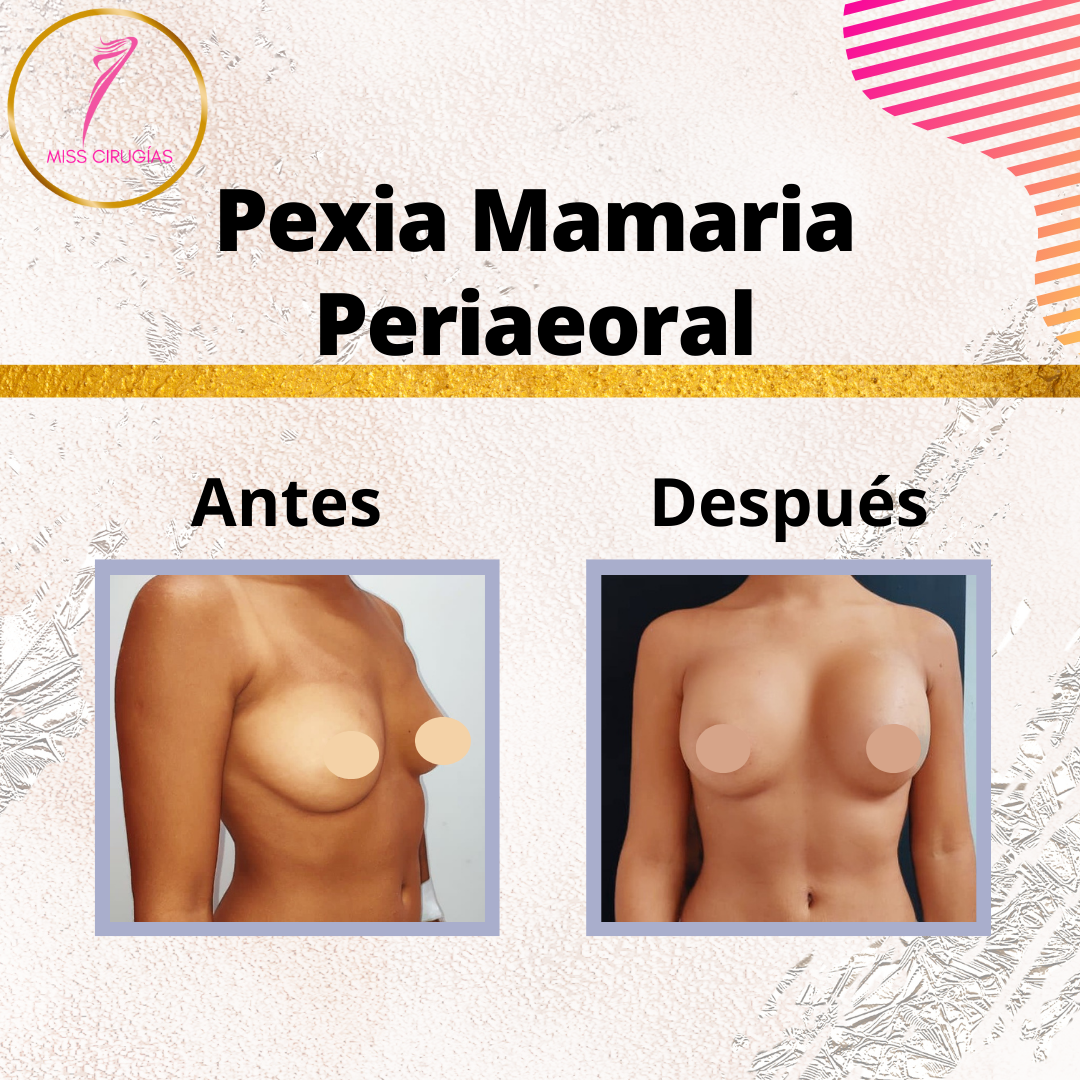 mastopexia-pexia-misscirugias