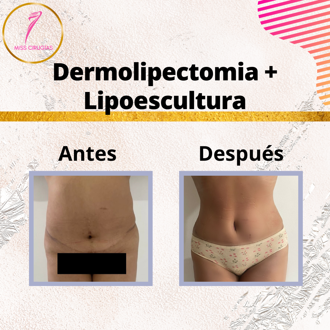 liposuccion-lipoescultura-dermolipectomia