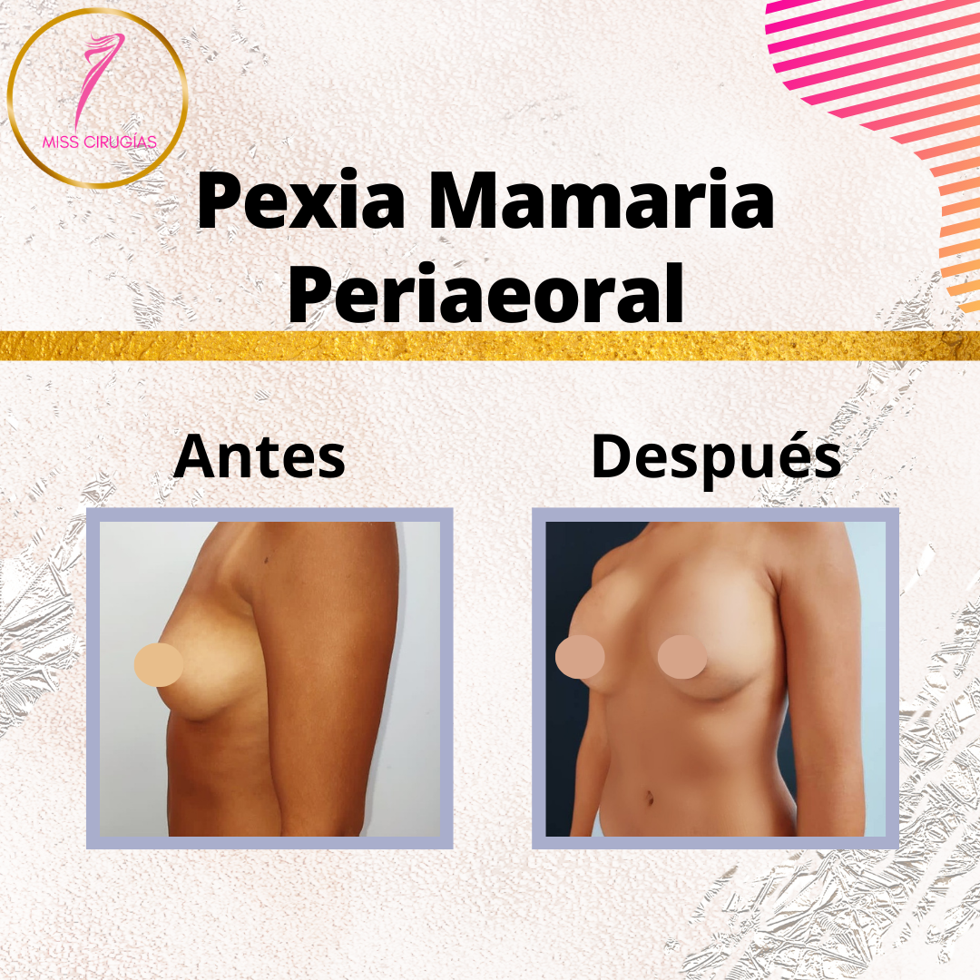mastopexia-pexia-misscirugias