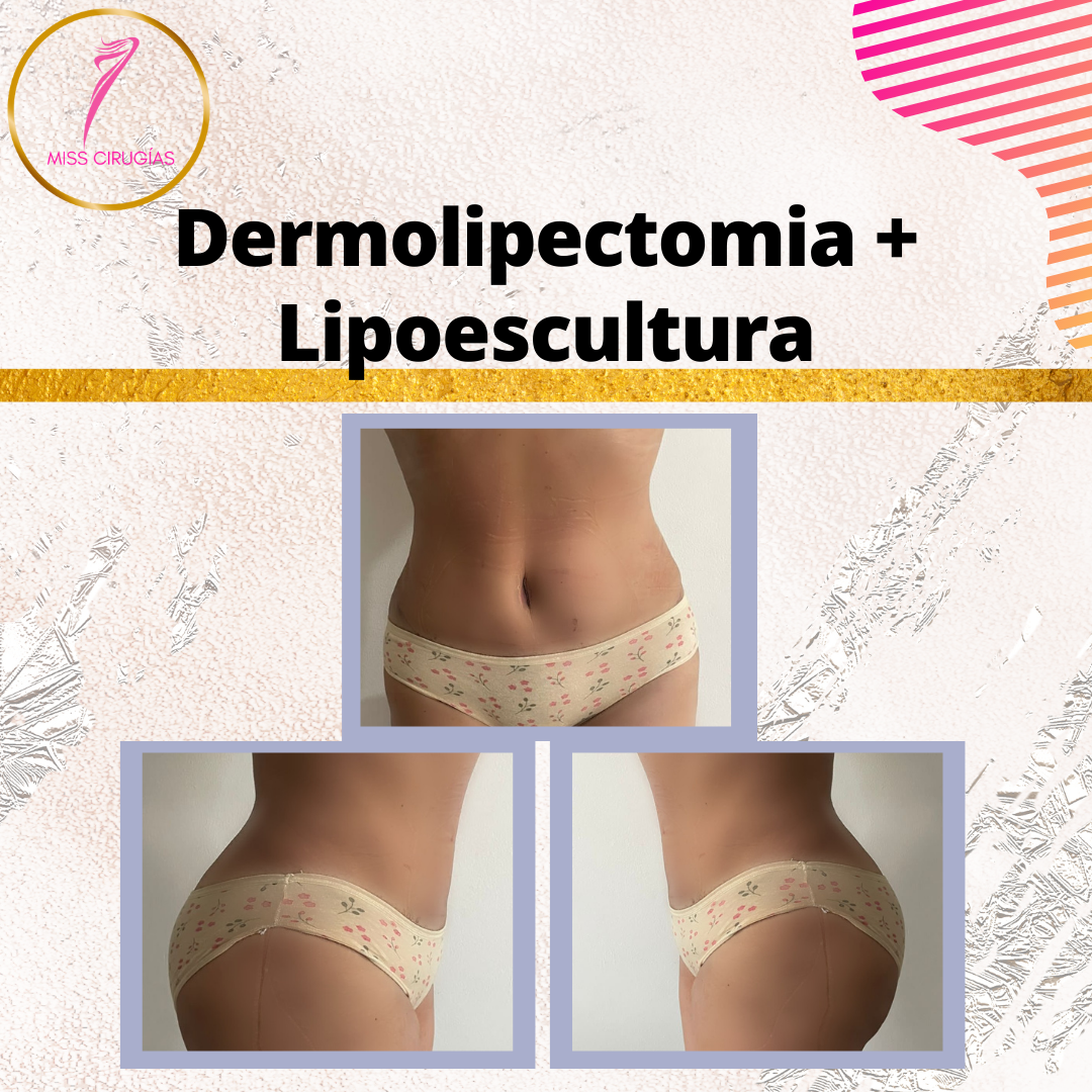 liposuccion-lipoescultura-dermolipectomia