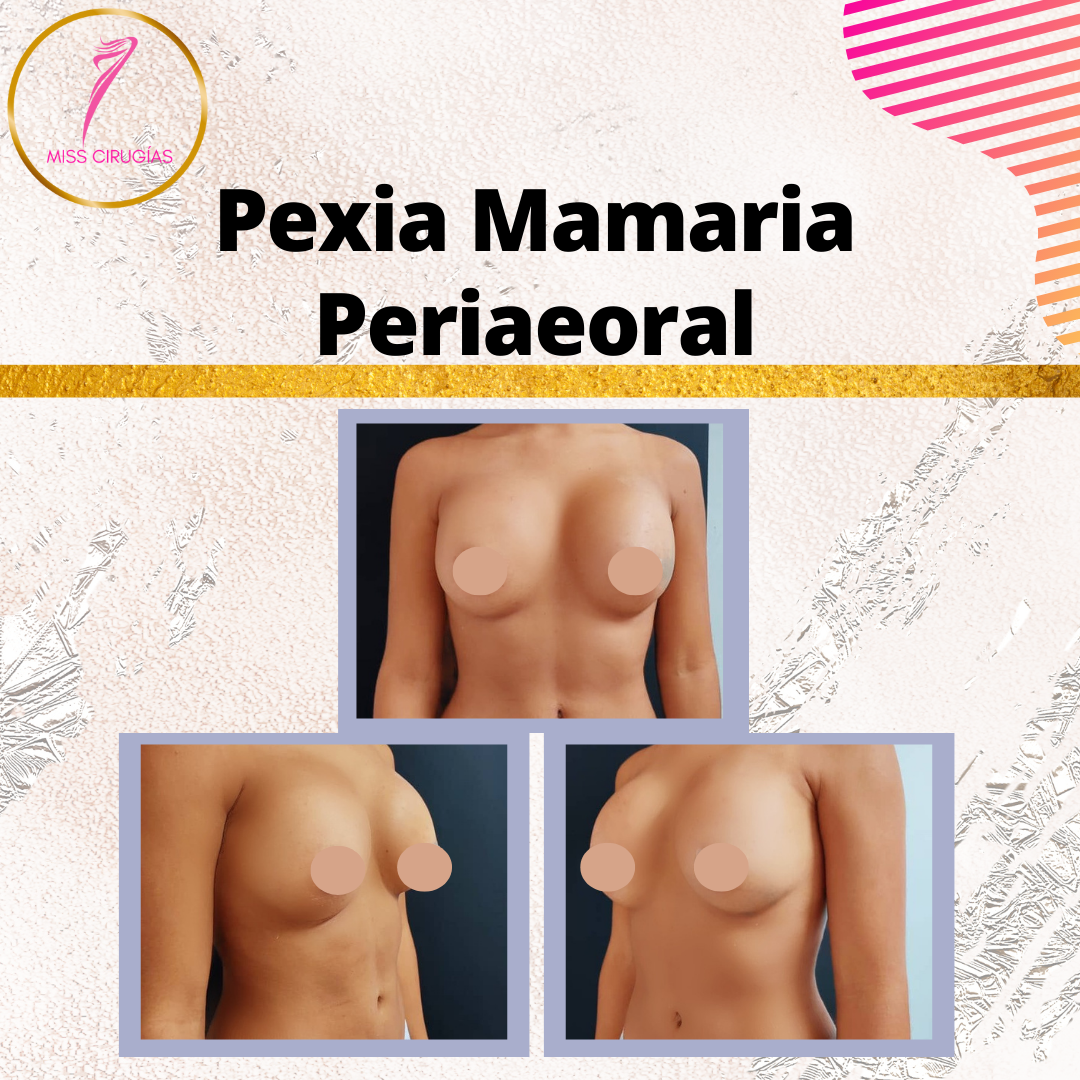 pexia-mamaria-periaeoral