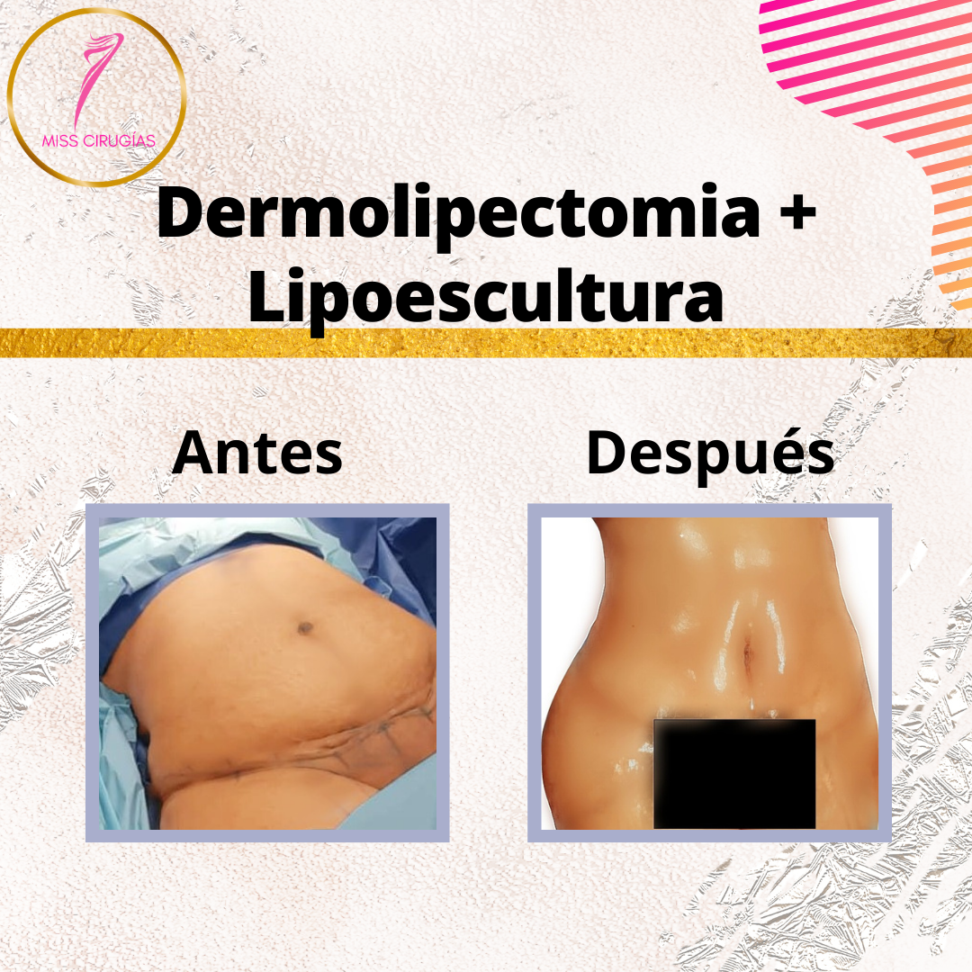 liposuccion-lipoescultura-dermolipectomia