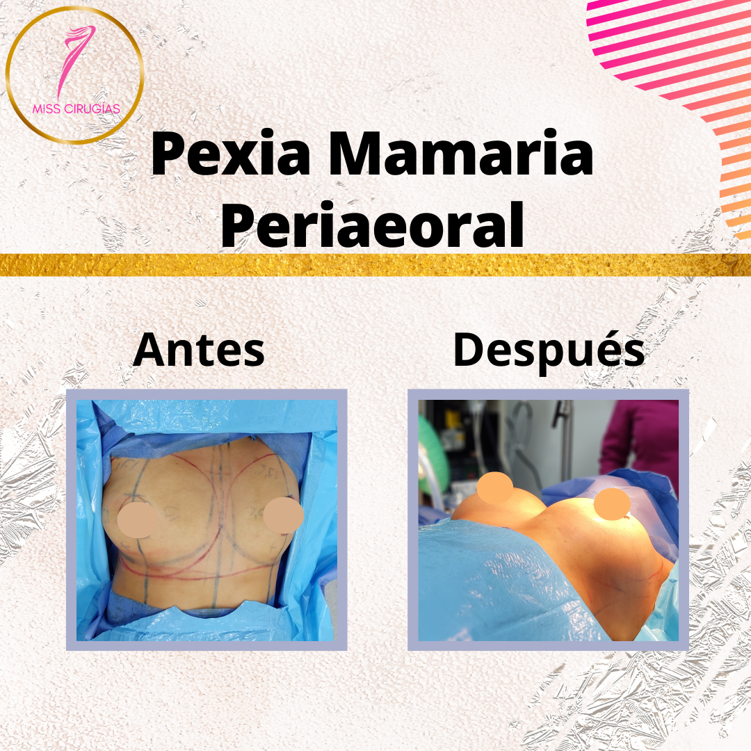 mastopexia-pexia-misscirugias