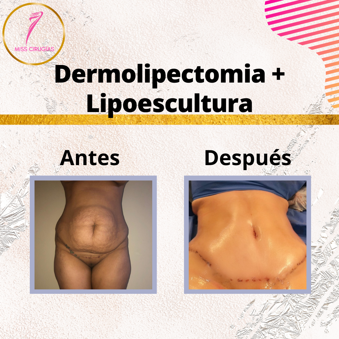 liposuccion-lipoescultura-dermolipectomia