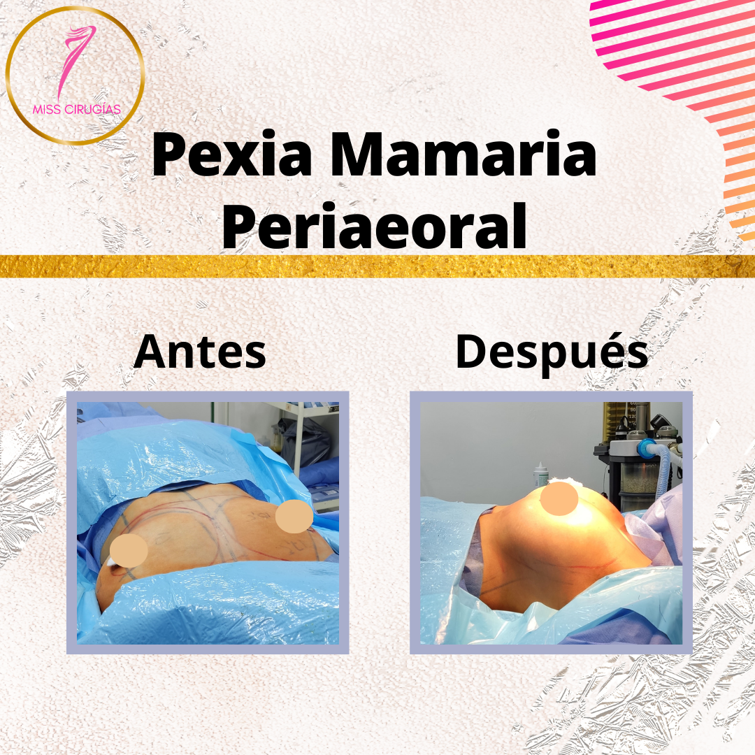 mastopexia-pexia-misscirugias