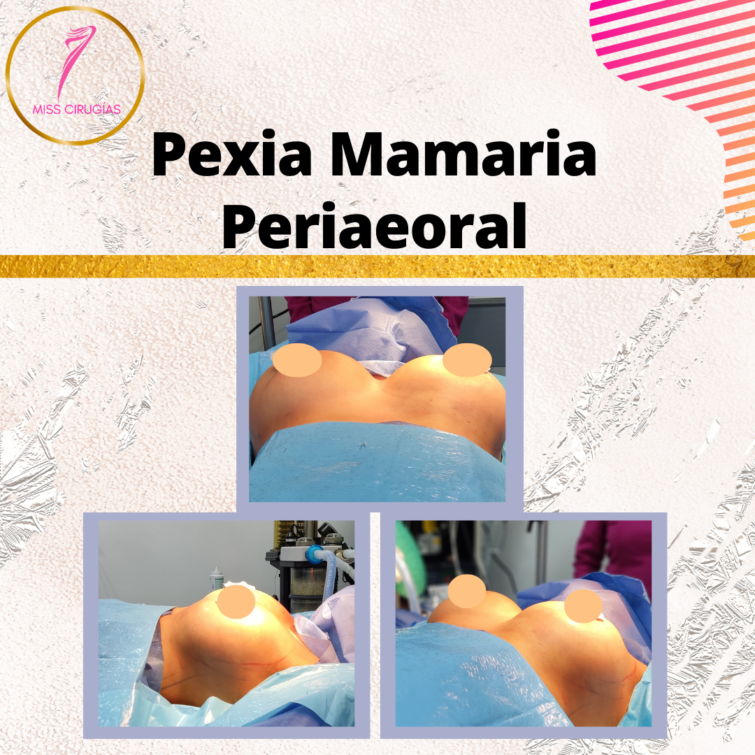 mastopexia-pexia-misscirugias