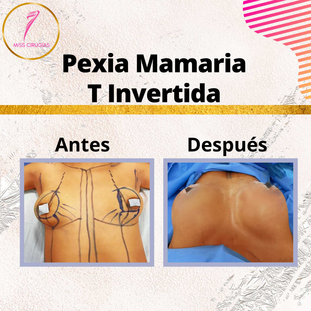 pexia-mastopexia