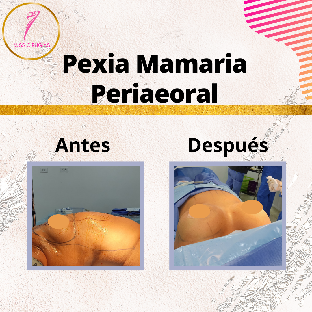 pexia-mamaria-misscirugias