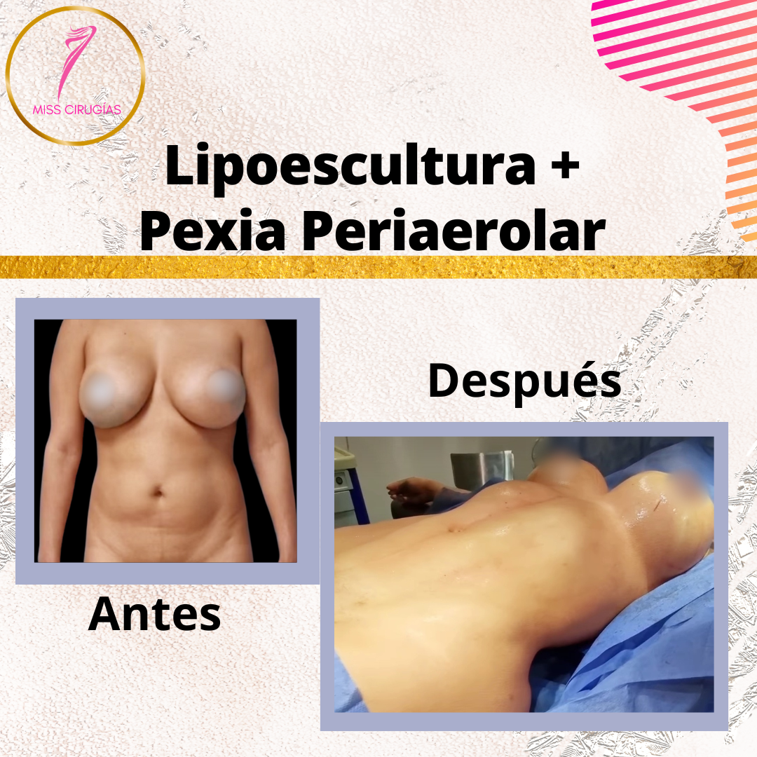liposuccion-lipoescultura-dermolipectomia