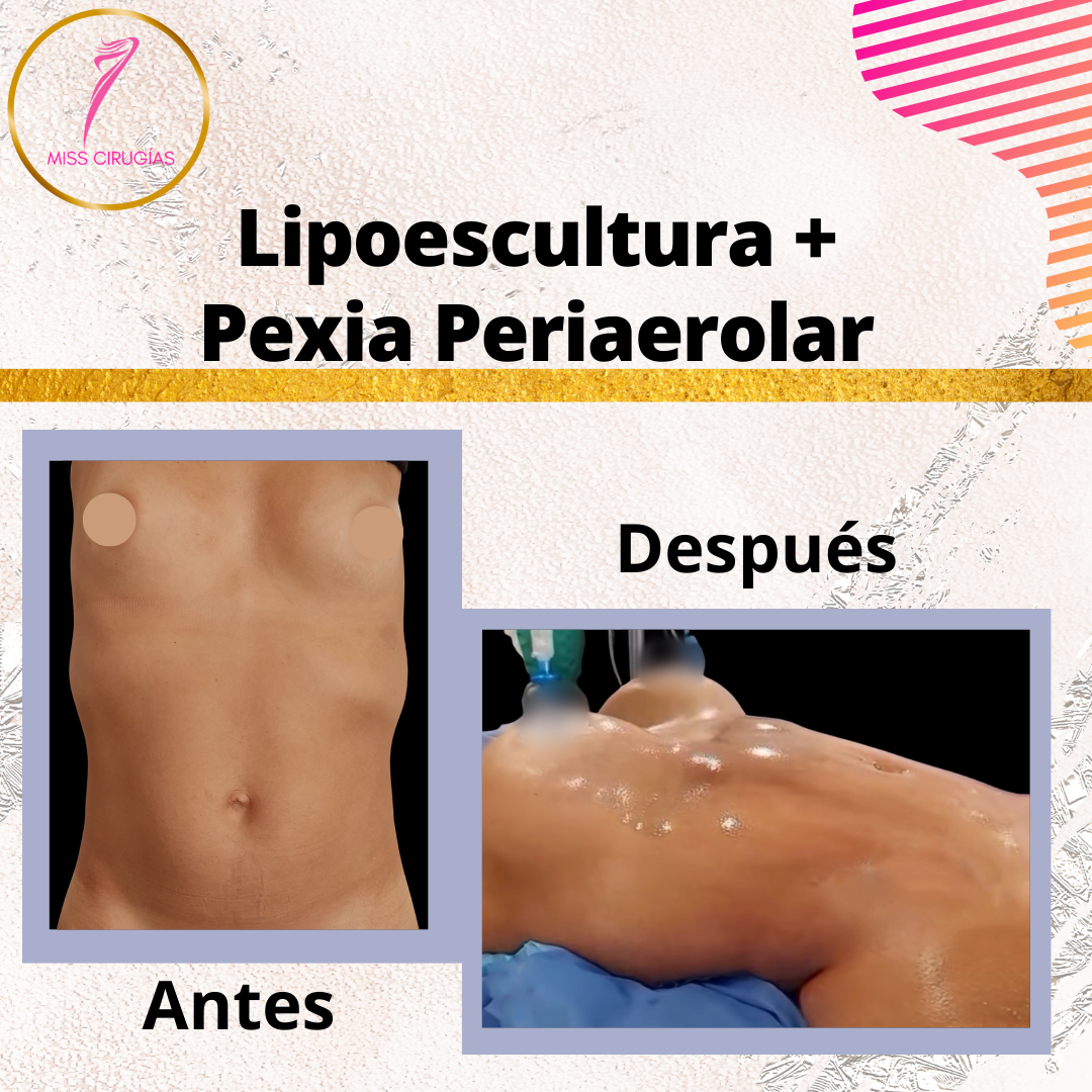liposuccion-lipoescultura-dermolipectomia