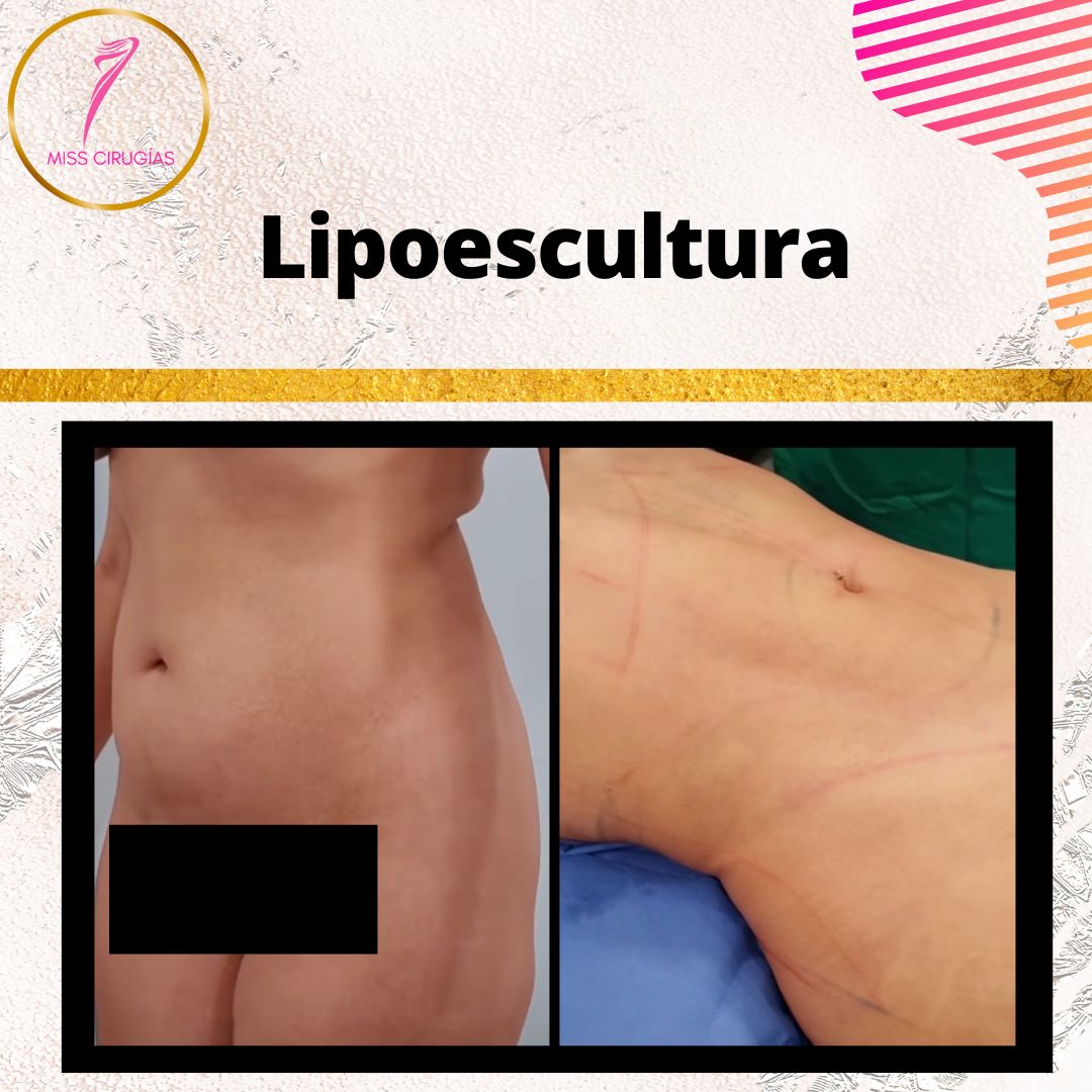 liposuccion-lipoescultura-dermolipectomia
