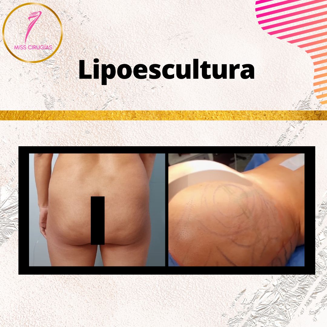 liposuccion-lipoescultura-dermolipectomia