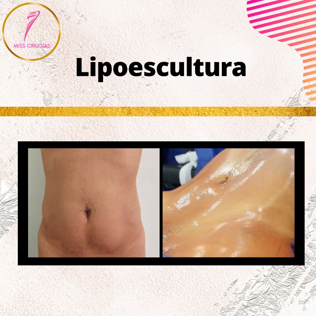 liposuccion-lipoescultura-dermolipectomia