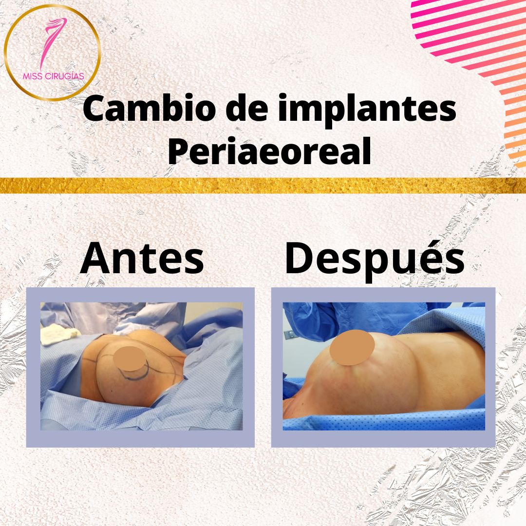 mamoplastia-pexia-mastopexia-misscirugias