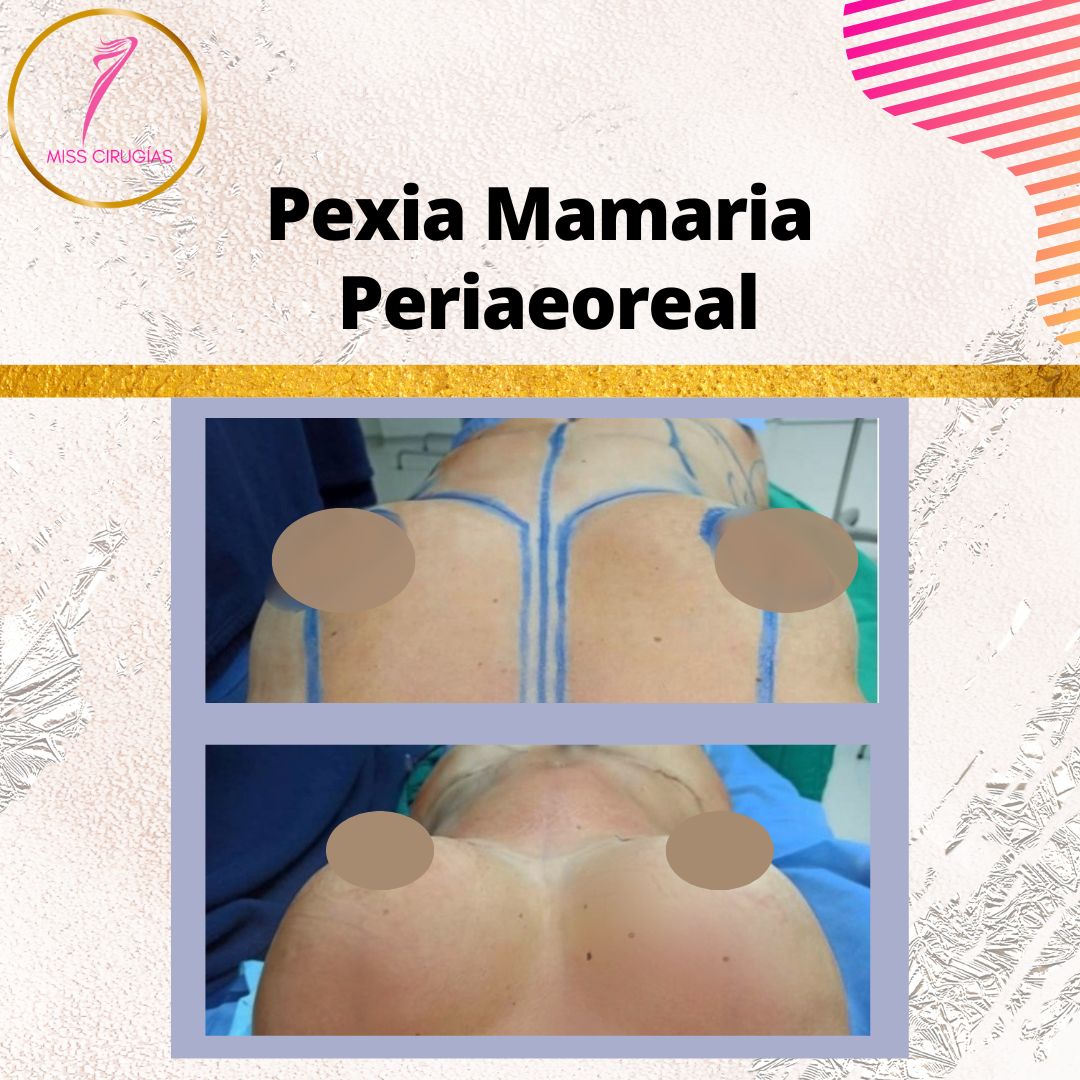 mamoplastia-pexia-mastopexia-misscirugias