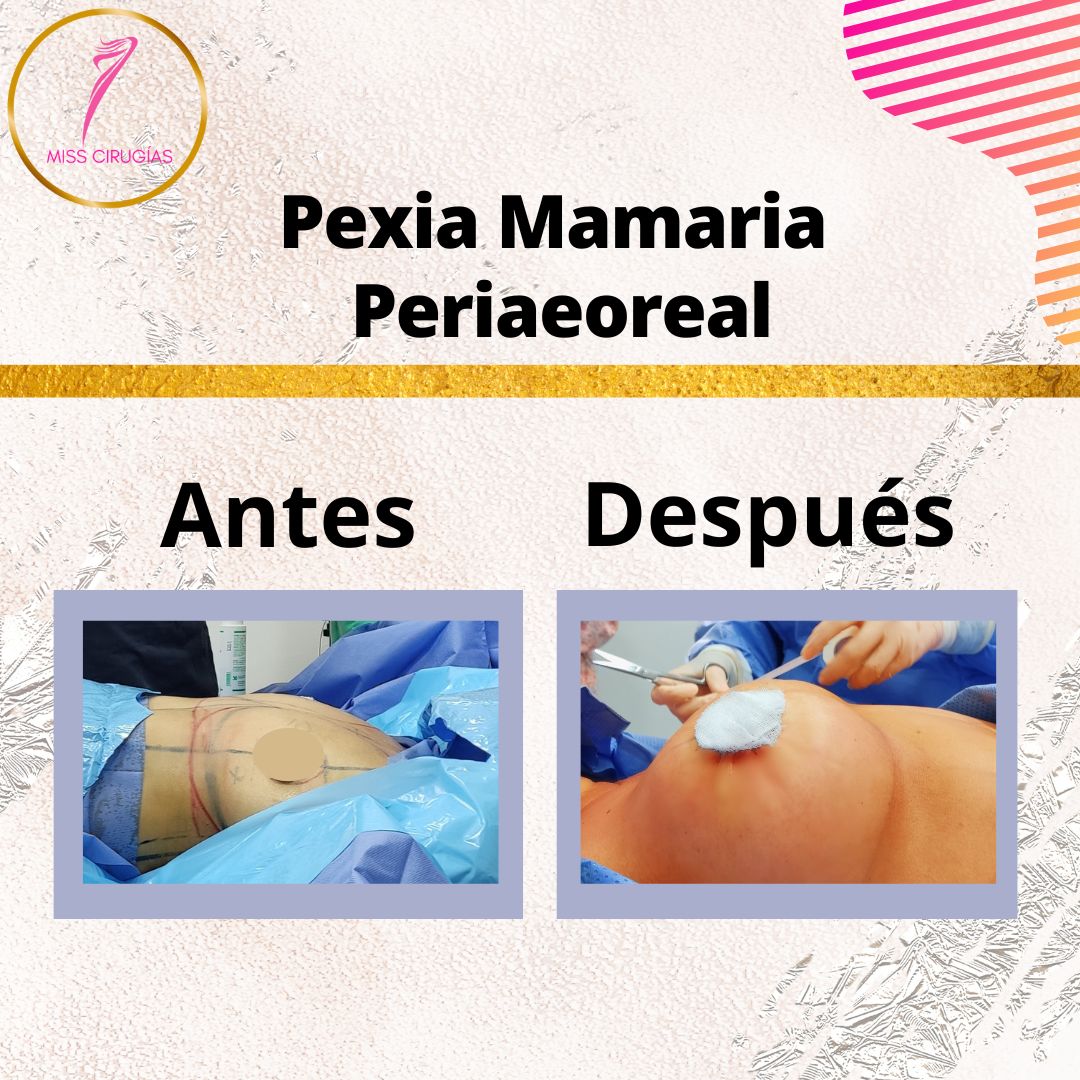 mamoplastia-pexia-mastopexia-misscirugias