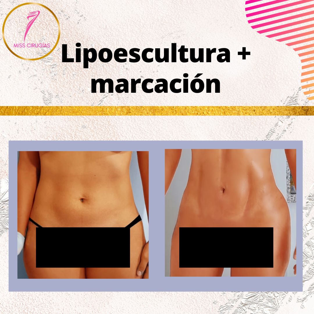 liposuccion-lipoescultura-dermolipectomia