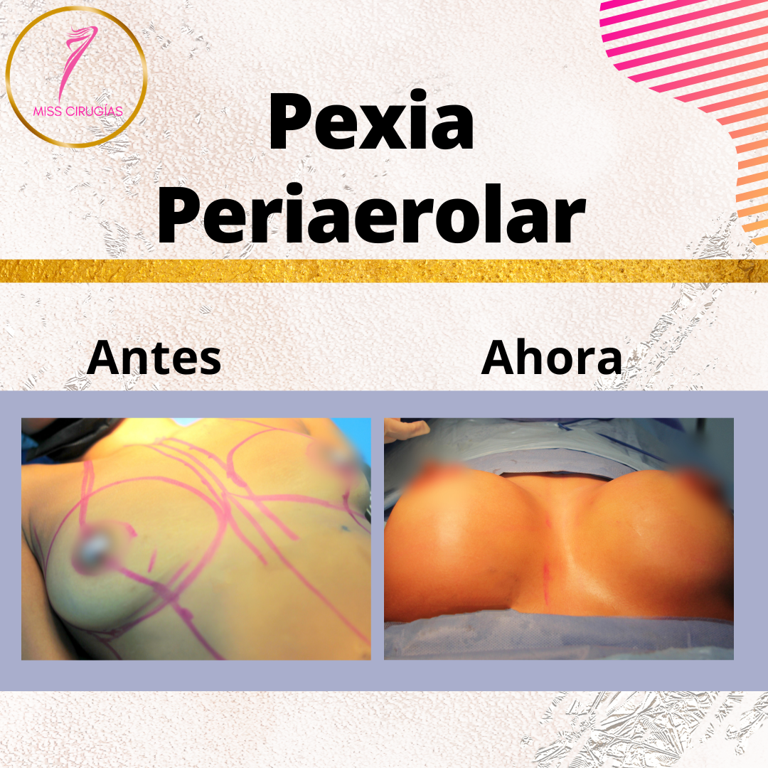 mamoplastia-pexia-mastopexia-misscirugias