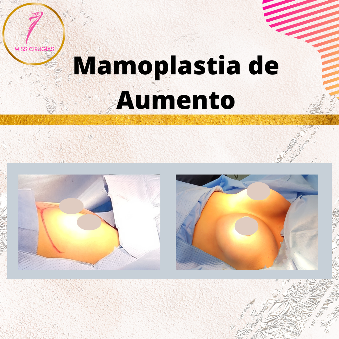 mamoplastia-pexia-mastopexia-misscirugias