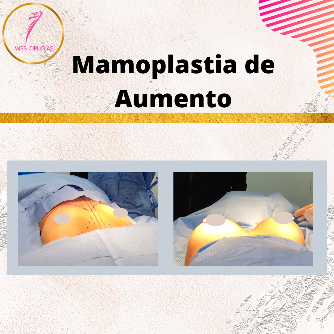 mamoplastia-pexia-mastopexia-misscirugias
