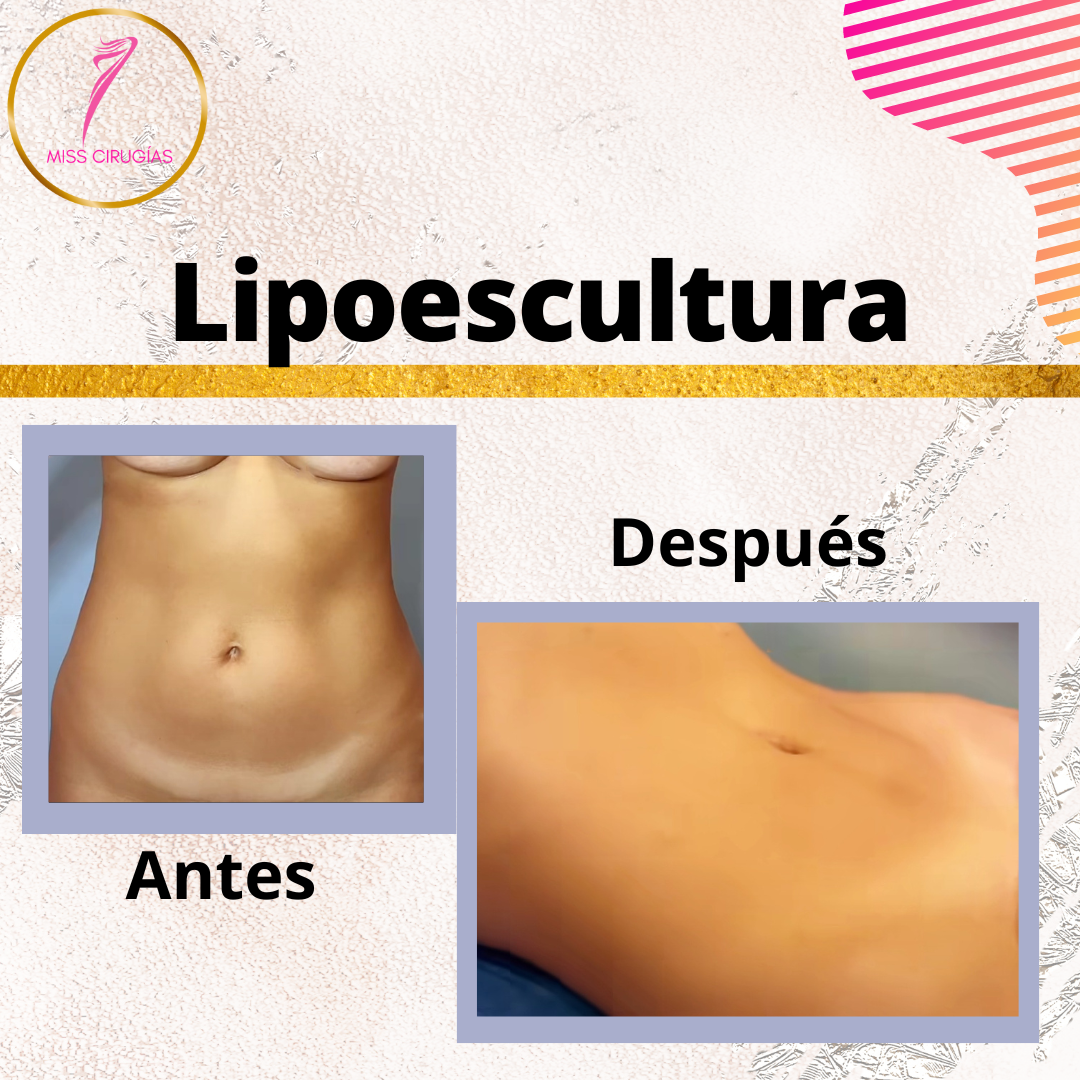 liposuccion-lipoescultura-dermolipectomia