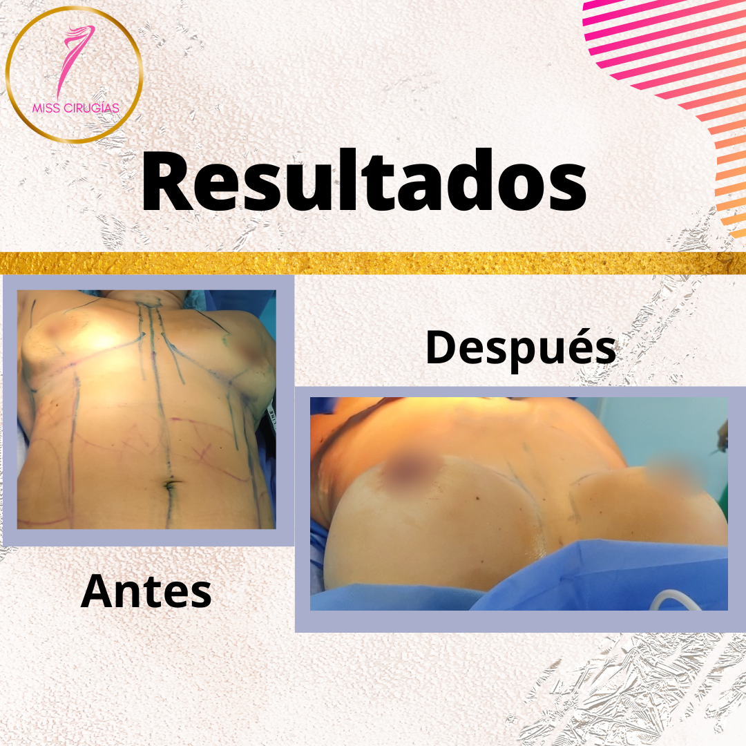 mamoplastia-pexia-mastopexia-misscirugias