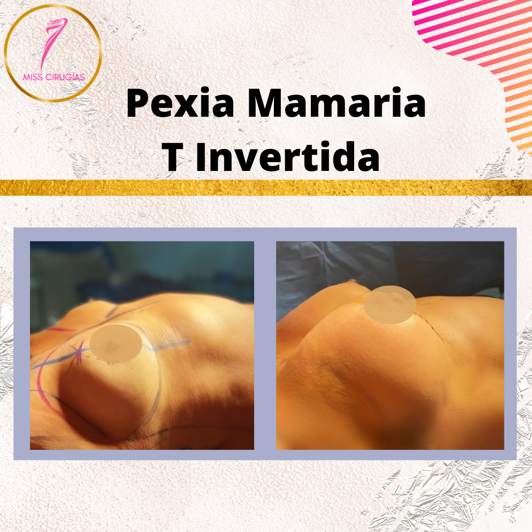mamoplastia-pexia-mastopexia-misscirugias