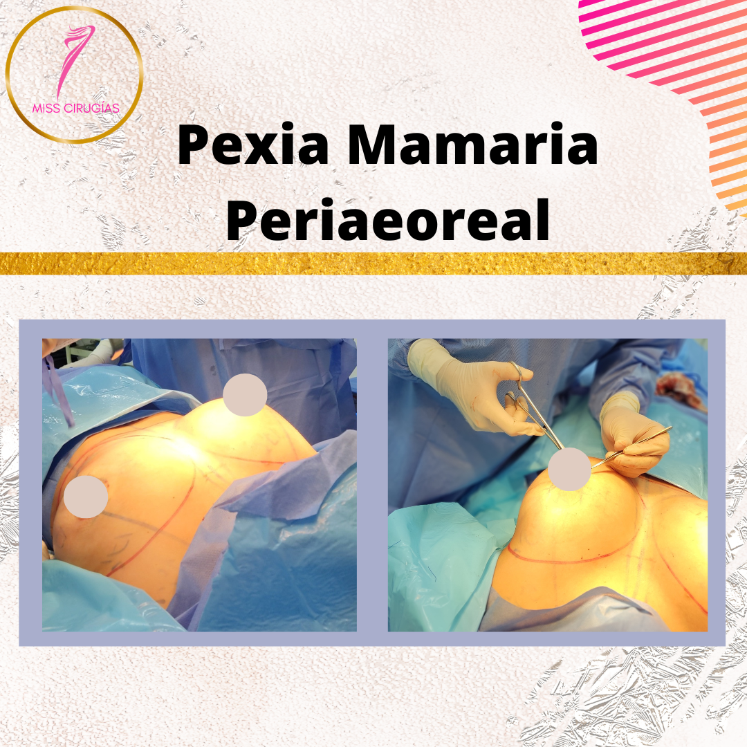 mamoplastia-pexia-mastopexia-misscirugias