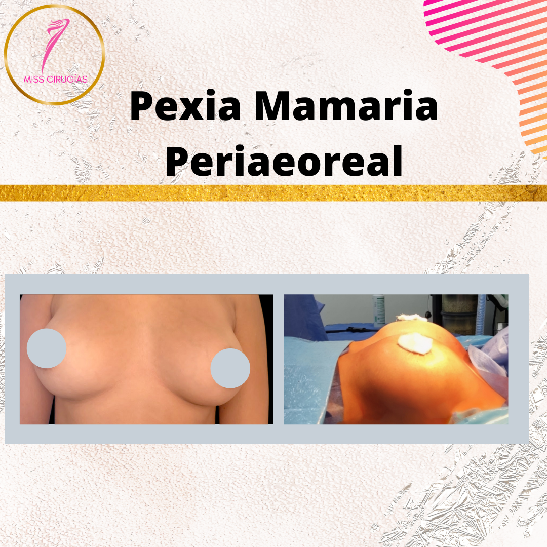 mamoplastia-pexia-mastopexia-misscirugias