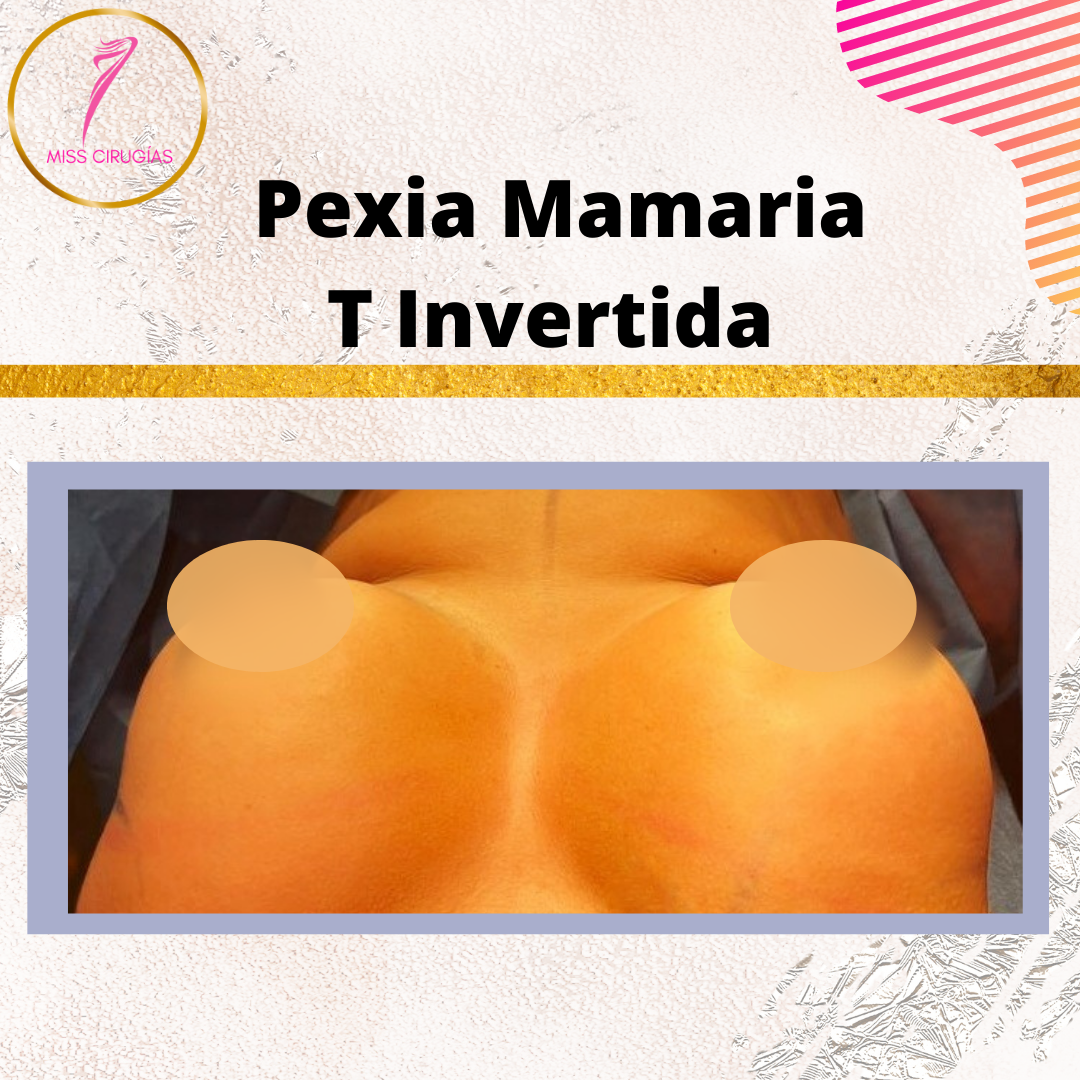 mamoplastia-pexia-mastopexia-misscirugias
