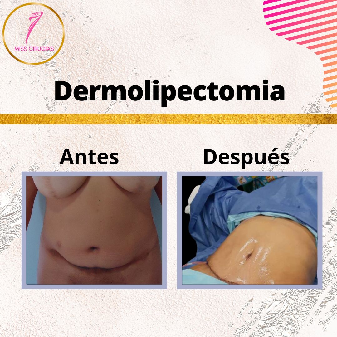 liposuccion-lipoescultura-dermolipectomia