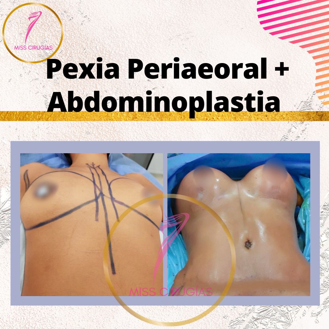 liposuccion-lipoescultura-dermolipectomia