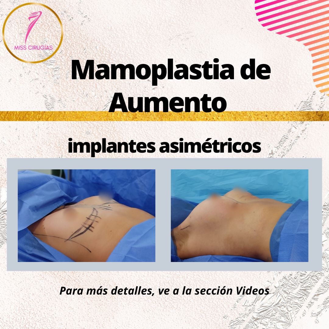 mamoplastia-pexia-mastopexia-misscirugias