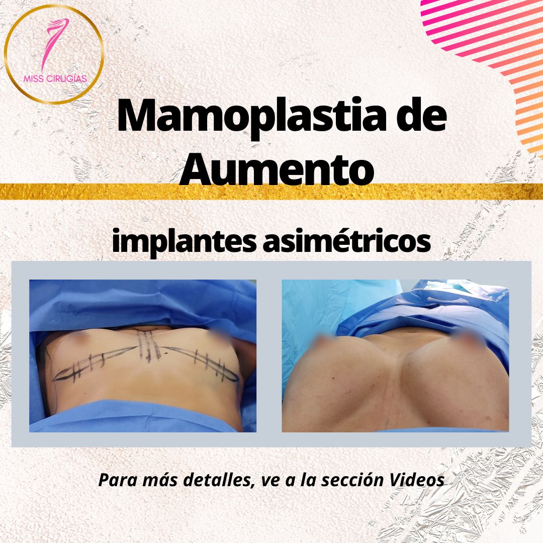 mamoplastia-pexia-mastopexia-misscirugias