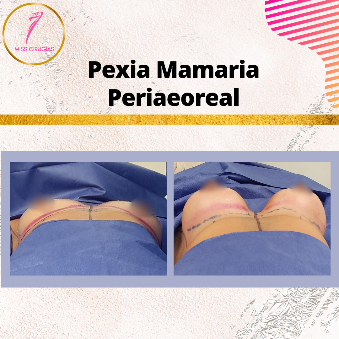 mamoplastia-pexia-mastopexia-misscirugias
