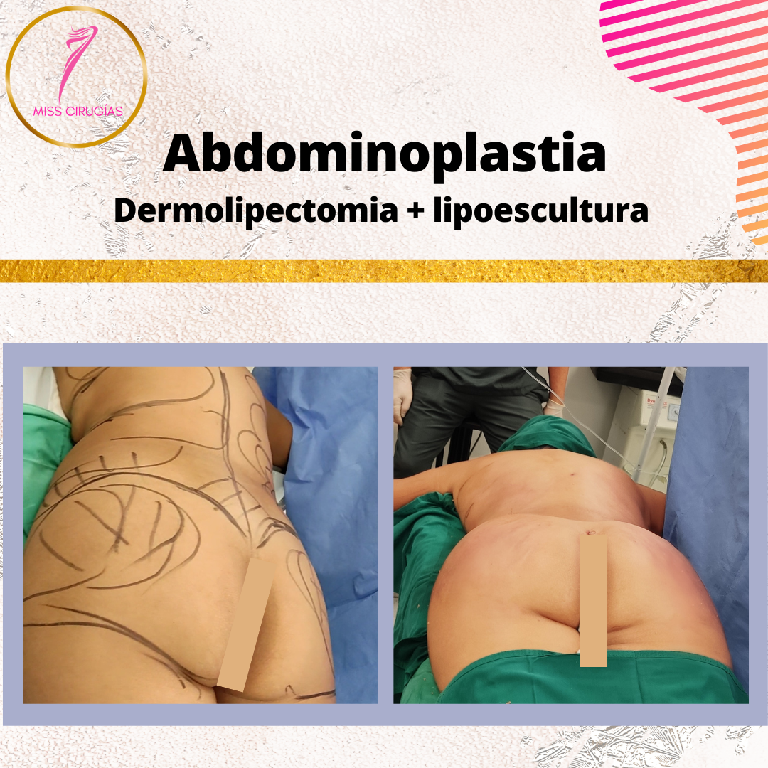 liposuccion-lipoescultura-dermolipectomia